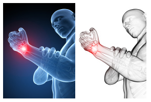 Milwaukee Carpal Tunnel Doctor