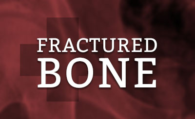 Milwaukee Fractured Bone Doctor