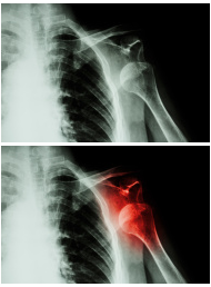 Milwaukee Shoulder Doctor Bankart Repair